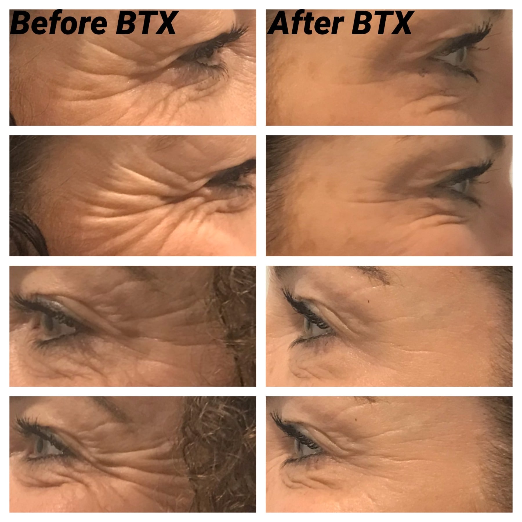 Botox, before after botox injection treatment wrinkles, anti aging, facial lines forehead eyebrow lift