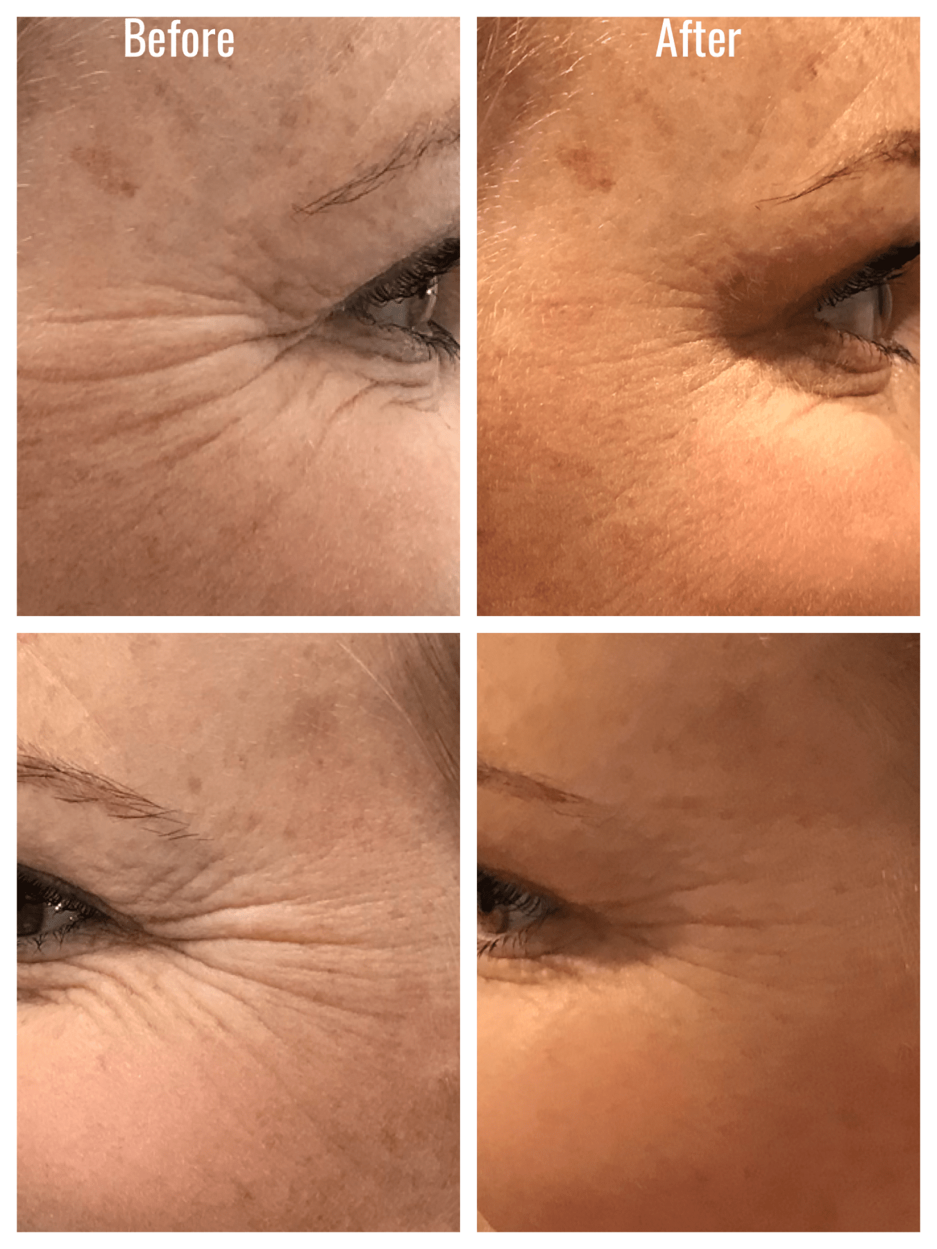 Botox, before after botox injection treatment wrinkles, anti aging, facial lines forehead eyebrow lift