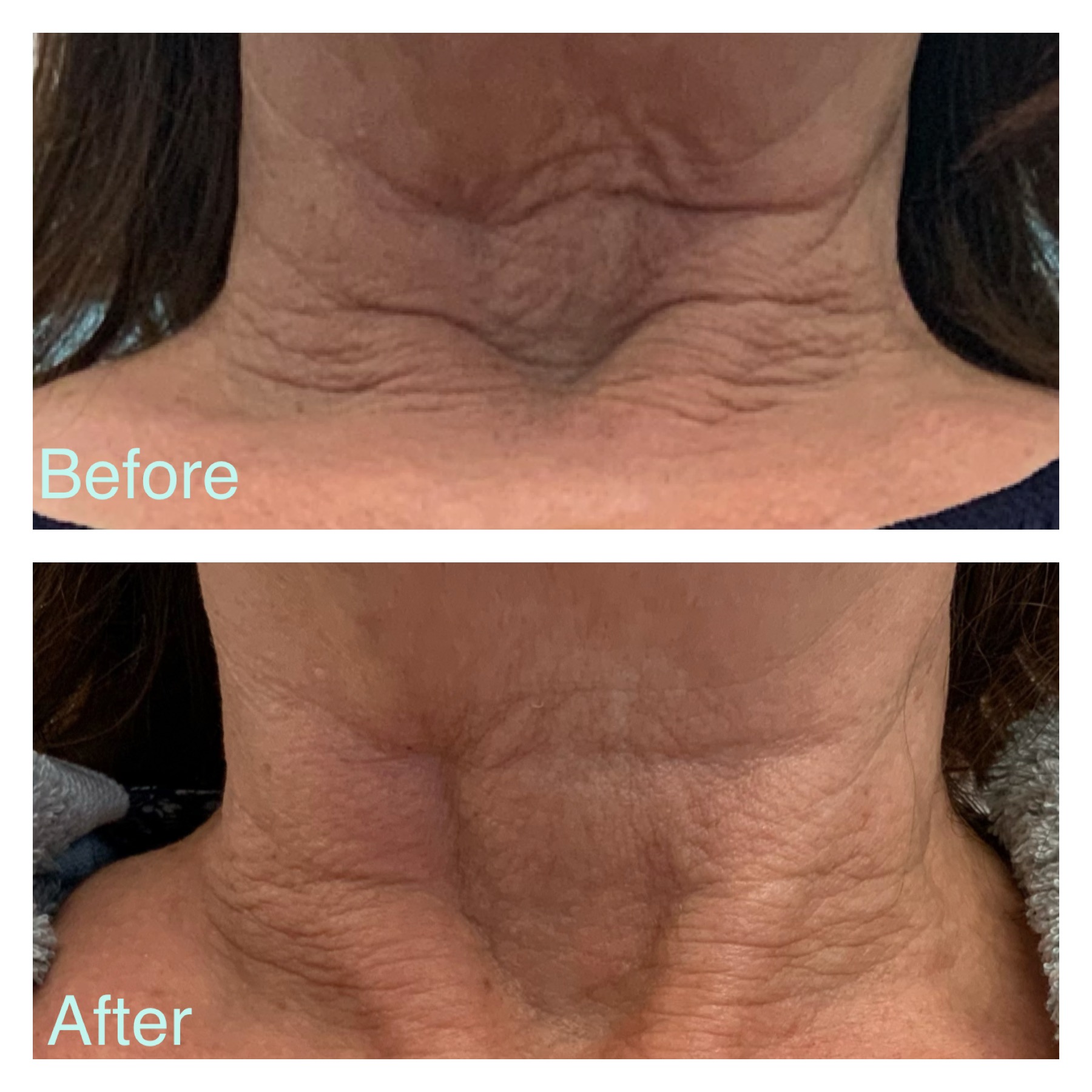 before after Profhilo treatment cost anti ageing wrinkles neck lines