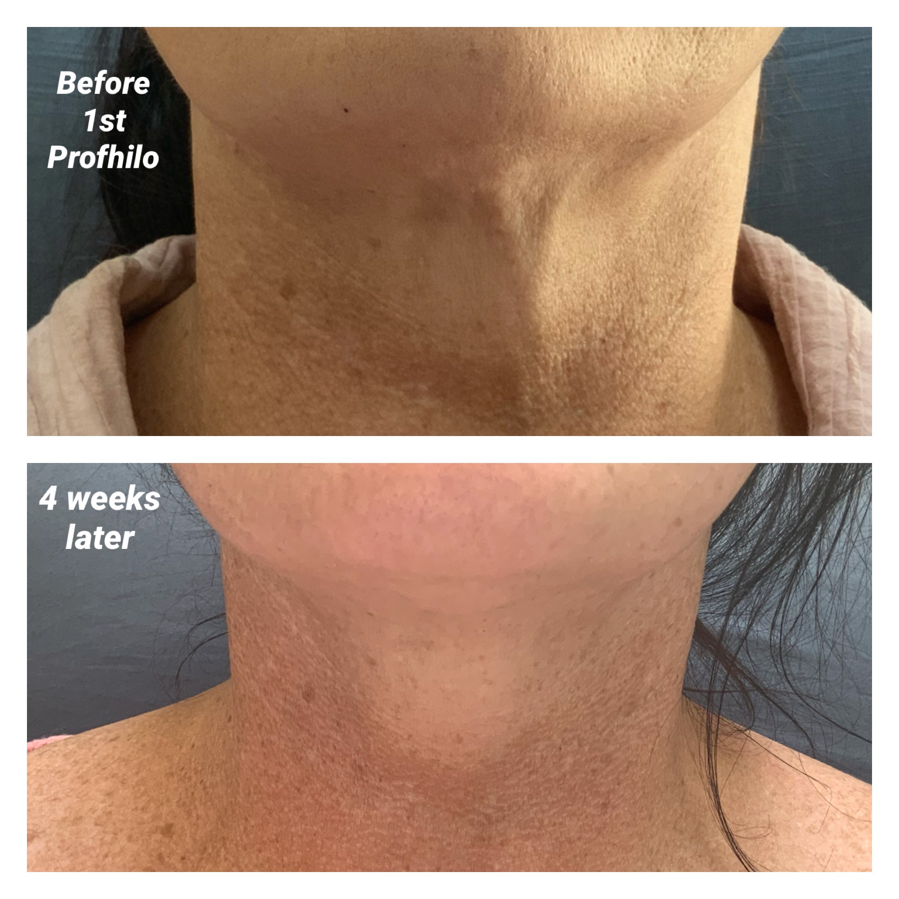 before after Profhilo treatment cost anti ageing wrinkles neck lines