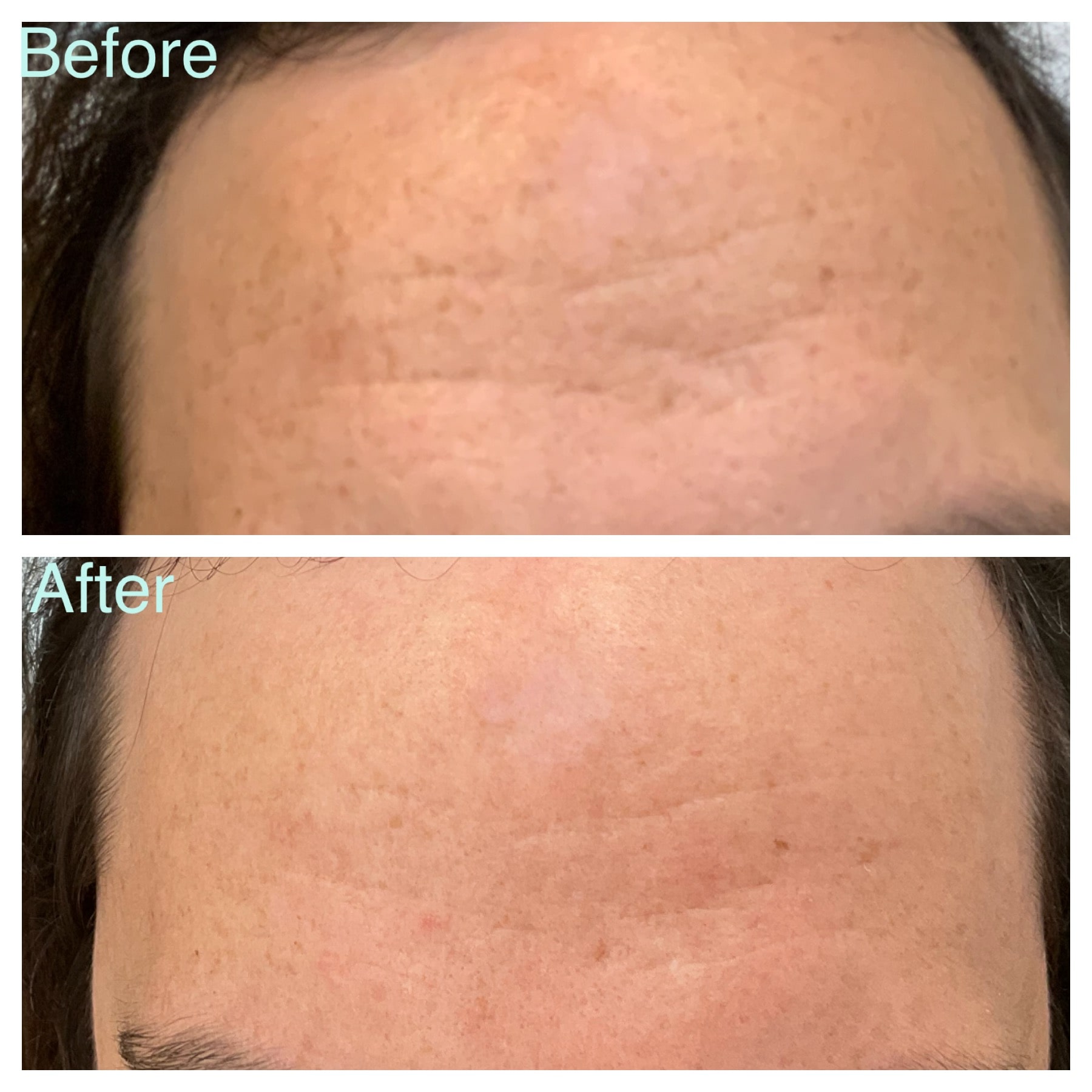 microneedling PRP Skin / facial Facial Rejuvenation skinpen