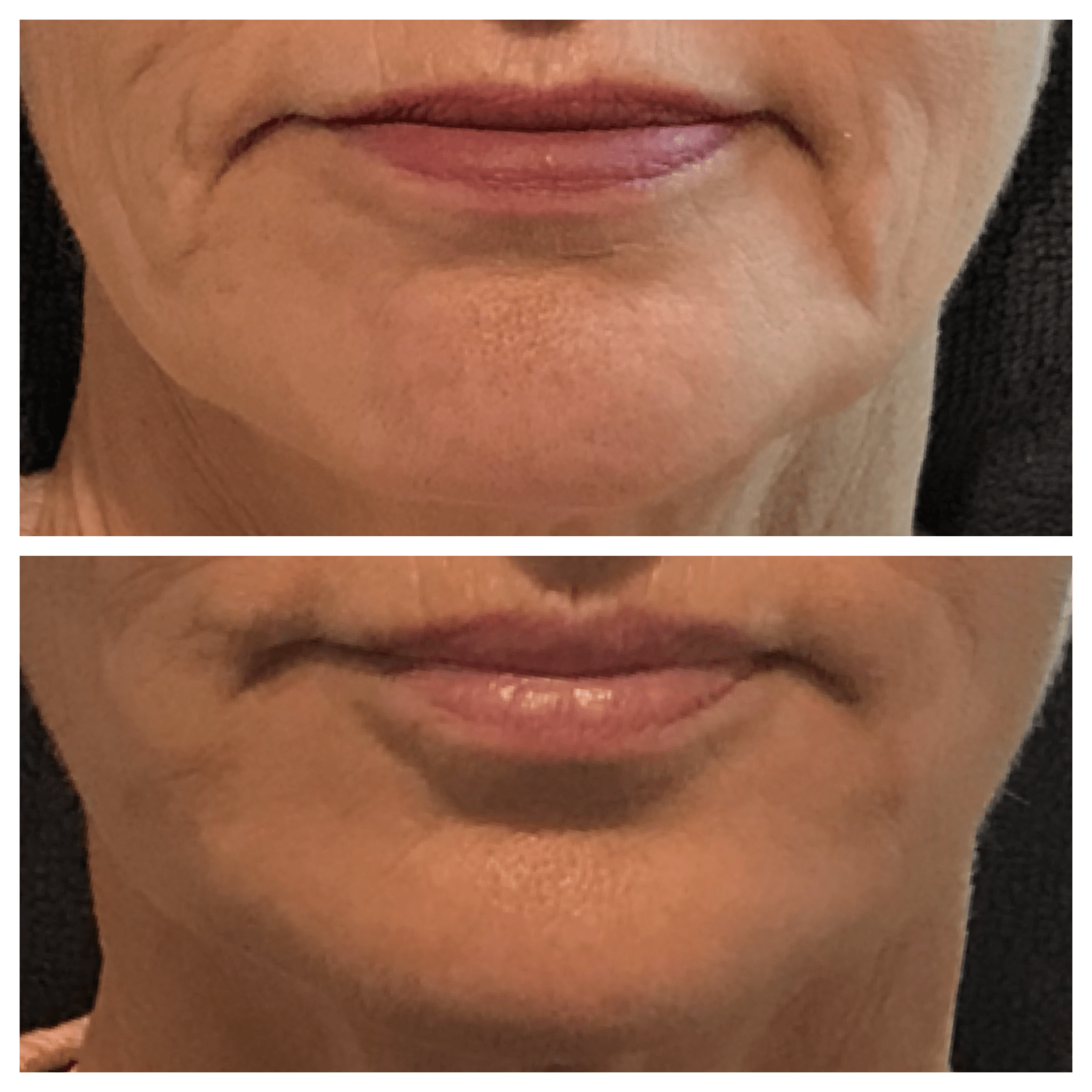 Lip filler injection dermal result treatment
