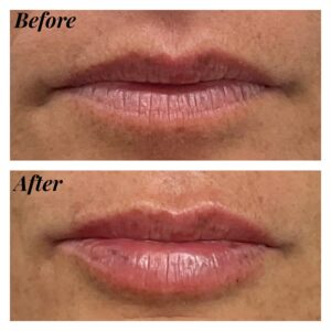 Lip filler injection dermal result treatment