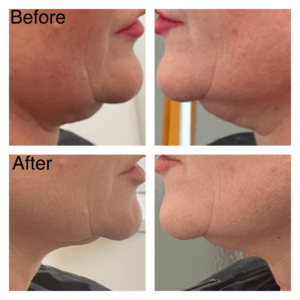 before after Belkyra treatment double chins non-surgical injection