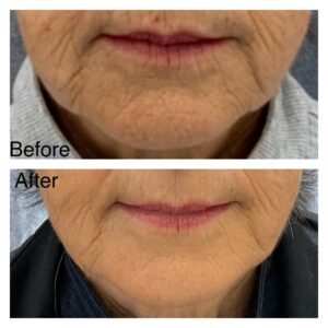 before after Radiesse treatment wrinkles collagen restore