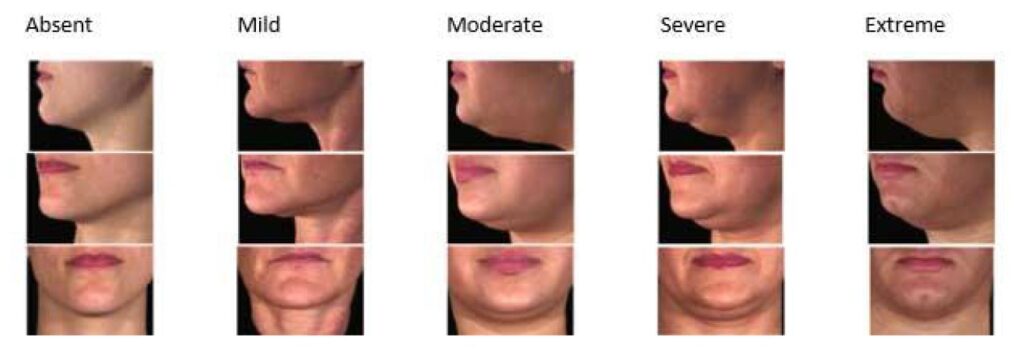 Double chin reduction (Belkyra®)