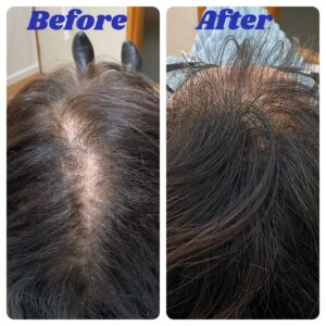 Hair loss before and after treatment (1)