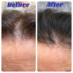 Hair loss before and after treatment (2)